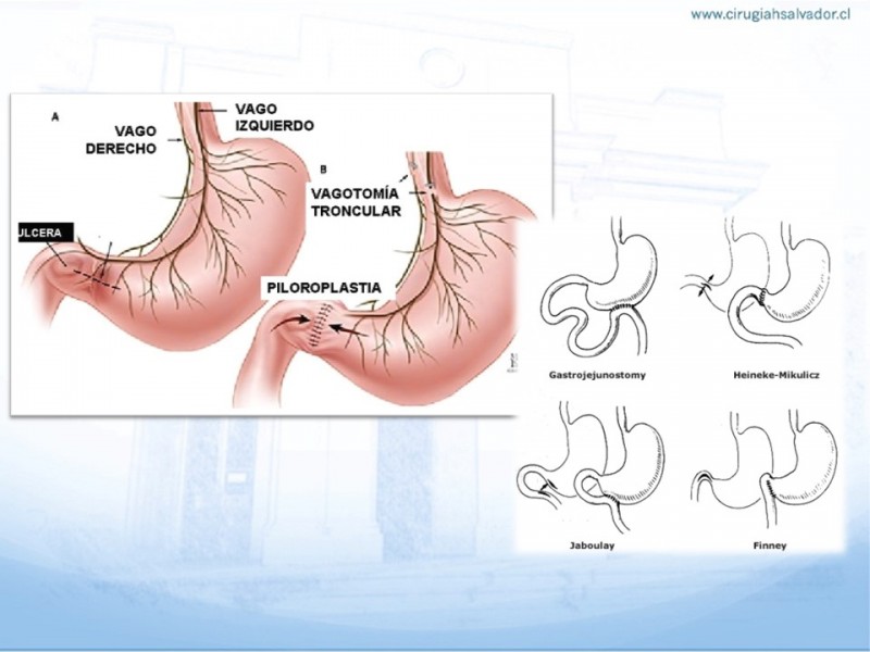 vagotomía y piloroplastia