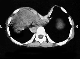 radiografía de pectus excavatum